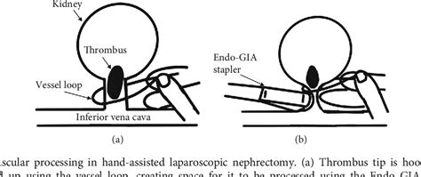 Image result for Hand-Assisted Nephrectomy
