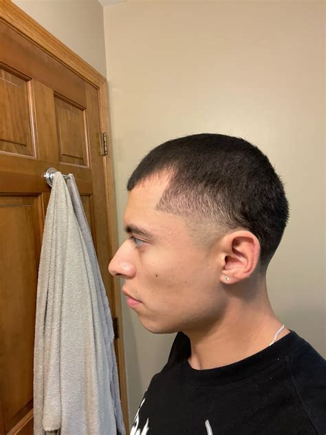 Normal Hairline Vs Receding