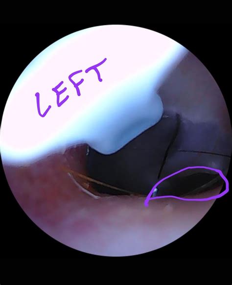 Is my eardrum punctured? : r/eardrums