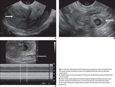 Figure 11—32 from Imaging Unusual Pregnancy Implantations: Rare Ectopic Pregnancies and More ...