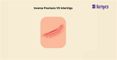 Inverse Psoriasis vs Intertrigo, Learn the features of each of them – Knya