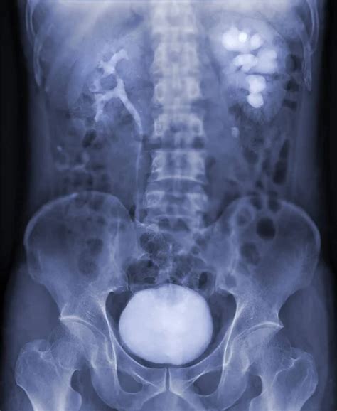 Image result for Contrast Pyelogram