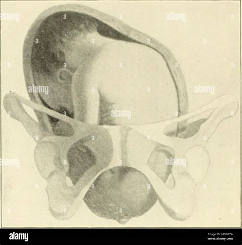 Breech position hi-res stock photography and images - Alamy