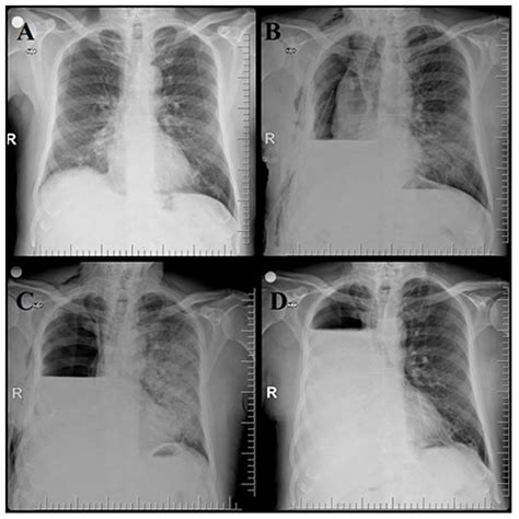 Clinical course of COVID-19 pneumonia in a patient undergoing pneumonectomy and pathology ...