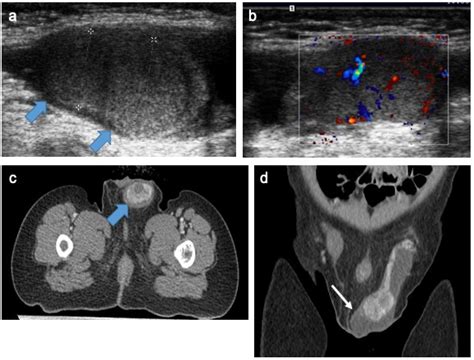 Testicular Cyst Vs Cancer
