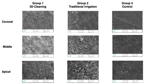 Effectiveness of Different Irrigation Techniques on Post Space Smear ...