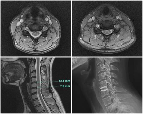 Cervical Spine Mri Report