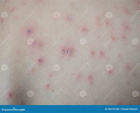 Treatment of Ulcers from Chickenpox, Varicella with Medical Cream on the Kid Skin Stock Image ...