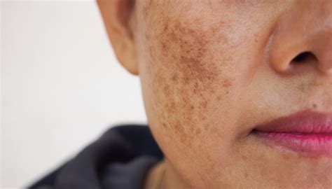 How Do I Get Rid Of Melasma (Dark Patches) On My Face – SkinKraft