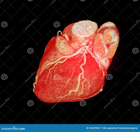 CT Cardiac 3D Or CTA Coronary Artery Royalty-Free Stock Photo | CartoonDealer.com #256229067