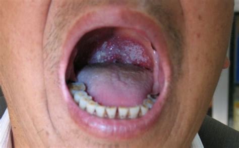 口腔念珠菌病的临床表现是什么？口腔念珠菌感染症状有哪些？[图]_优优健康网