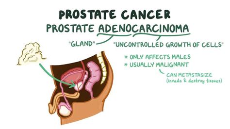 Prostate Cancer 的图像结果