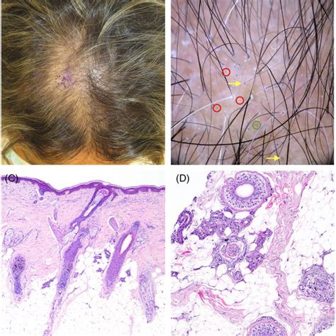 Image result for Diffuse Alopecia