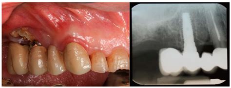 Dental Implant Survival and Risk of Medication-Related Osteonecrosis in ...