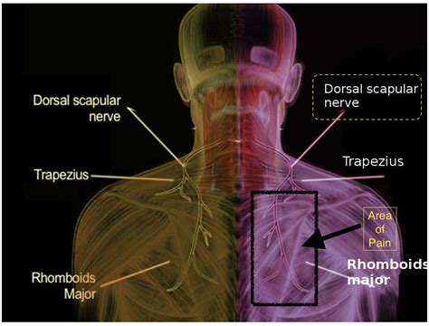 Dorsal scapular nerve | Patient information sheets