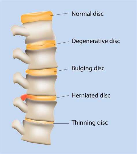 Cincinnati Ohio Degenerative Disc Disease | Disk | Disorder