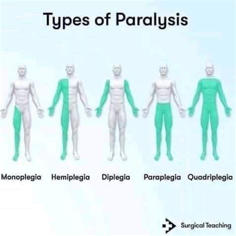 Paralysis 的图像结果
