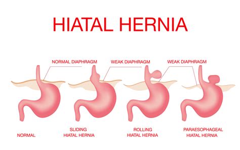 Hernia Hiatal Que Es Y Como Se Cura