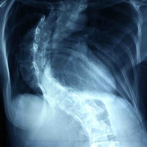 levoscoliosis of the lumbar spine - Captions Watch