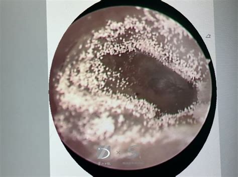 耳念珠菌是什么菌？ 耳念珠菌通过什么传染？|念珠|是什么-知识百科-川北在线