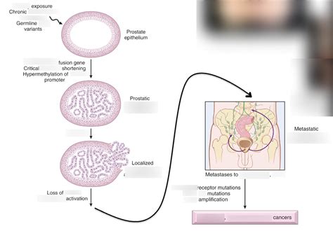 Prostate Cancer 的图像结果
