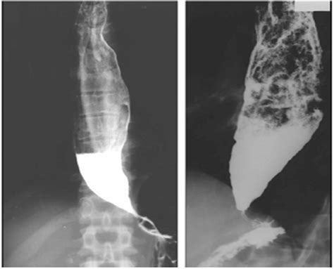 Serra doria procedure as an alternative treatment for end stage ...