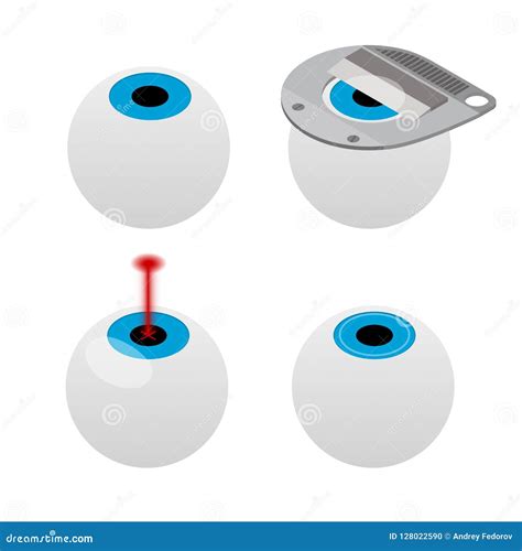 Laser Vision Correction 3D Medical Concept. Abstract Human Iris Modern Operation Surgery ...