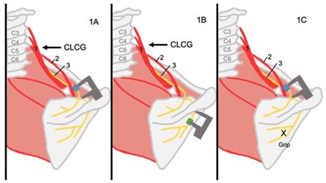 Effect of Contralateral Cervical Glide on the Suprascapular Nerve: An ...