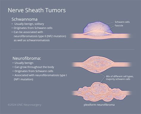 Nerve Sheath Tumor