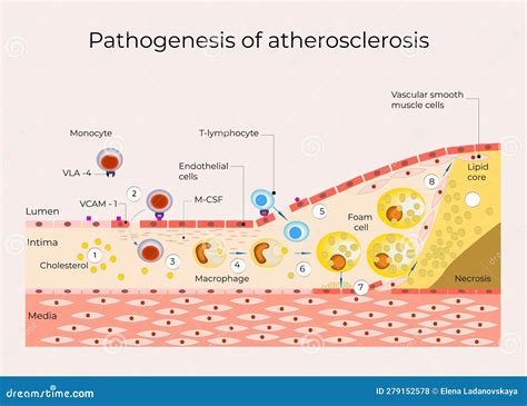 Atherosclerosis Pathogenesis