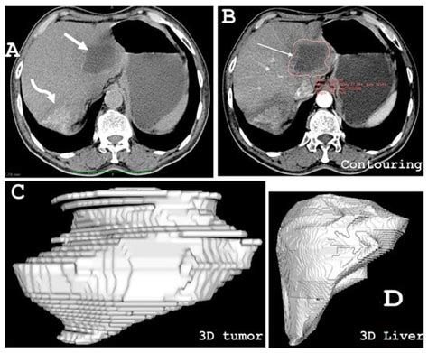A Case Series and Literature Review of Alveolar Echinococcosis in ...