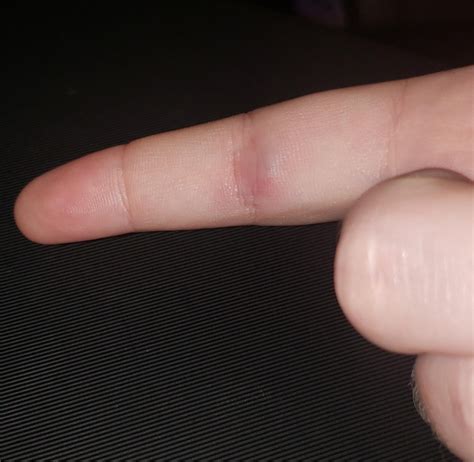 Had this swollen lump in the underside of my right index finger joint for two months now. Last ...