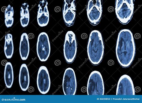 CT Scan of Brain Show Ischemic Stroke and Hemorrhagic Stroke Stock ...