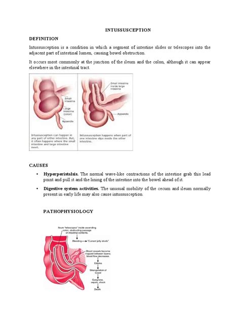 Image result for Definition of Intussusception