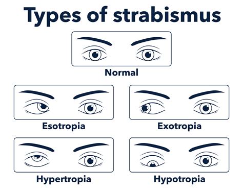 Lateral Vs Vertical Nystagmus at Tammy Hodges blog