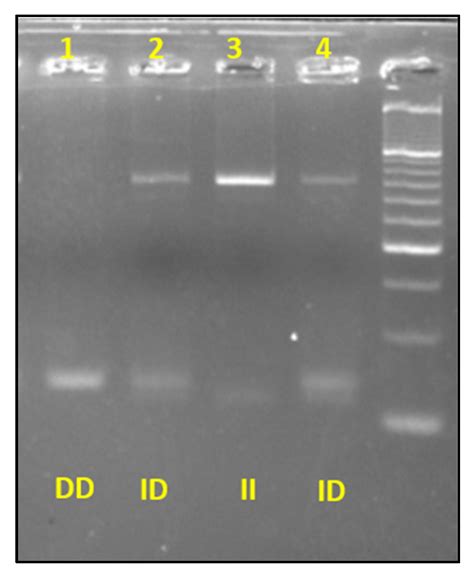 The Relationship between ACE, ACTN3 and MCT1 Genetic Polymorphisms and ...