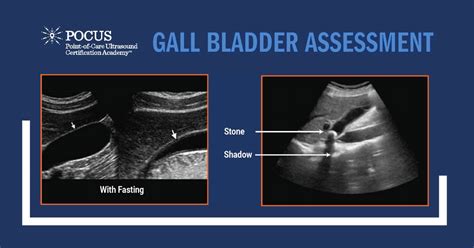 Image result for Gallbladder Test