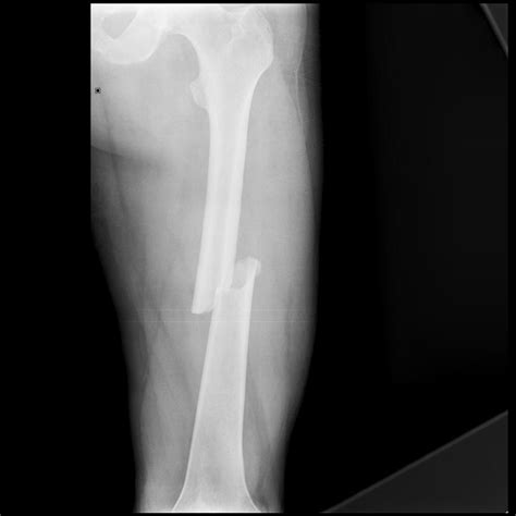 Fracture Femur Shaft