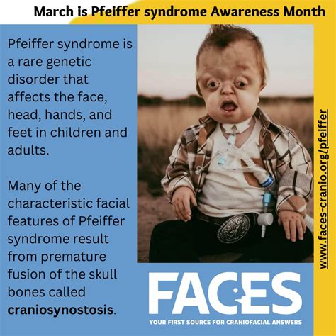 Pfeiffer syndrome is a rare genetic disorder (1 in 100,000 births) characterized by premature ...
