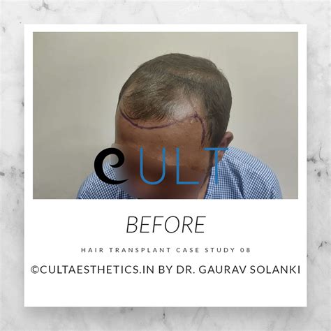 Hair Transplant Results 08Cult Aesthetics