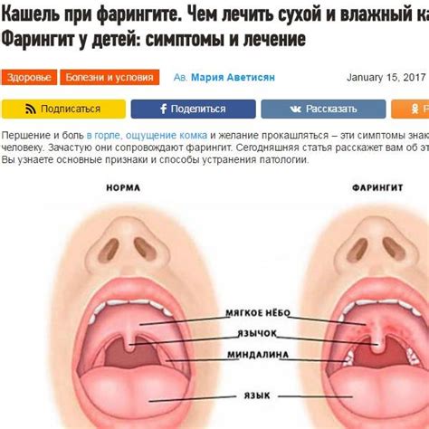 Хронический фарингит у взрослых: лечение препаратами, симптомы и отзывы