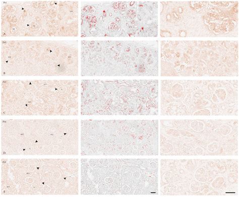 Spatio-Temporal Expression Pattern of CAKUT Candidate Genes DLG1 and ...