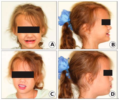 Full Mouth Rehabilitation of Two Siblings with Dentinogenesis Imperfecta Type II Using Different ...