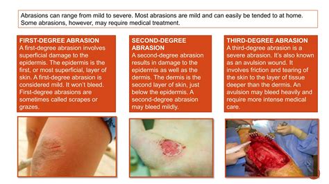Dressing Surgical Wounds, Abrasion and Lacerations | PPTX