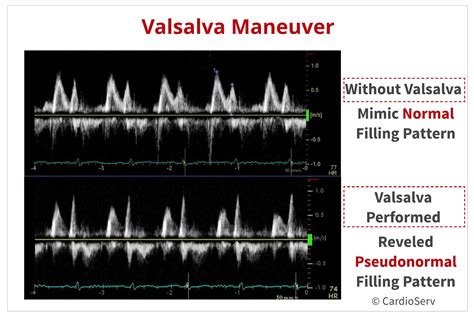Phases Of Valsalva Maneuver