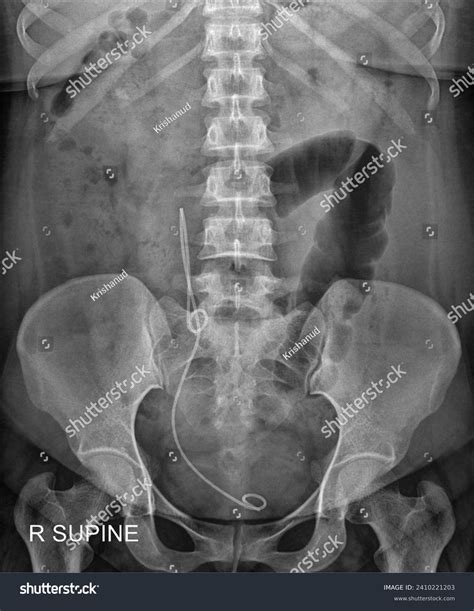 Xray Kub Kidney Ureter Bladder Radiograph Stock Photo 2410221203 ...