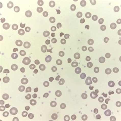 Burr Cells (Echinocytes): Hematology Bench & MLS Study Guide