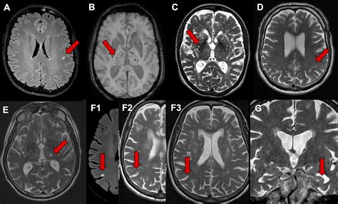 Neuroimaging in Dementia: More than Typical Alzheimer Disease | Radiology