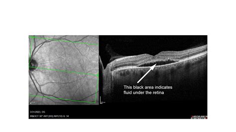 Central Serous Retinopathy Oct
