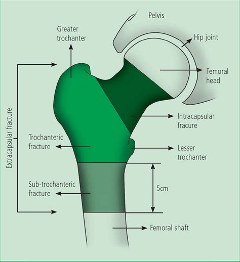 Femoral Head And Neck
